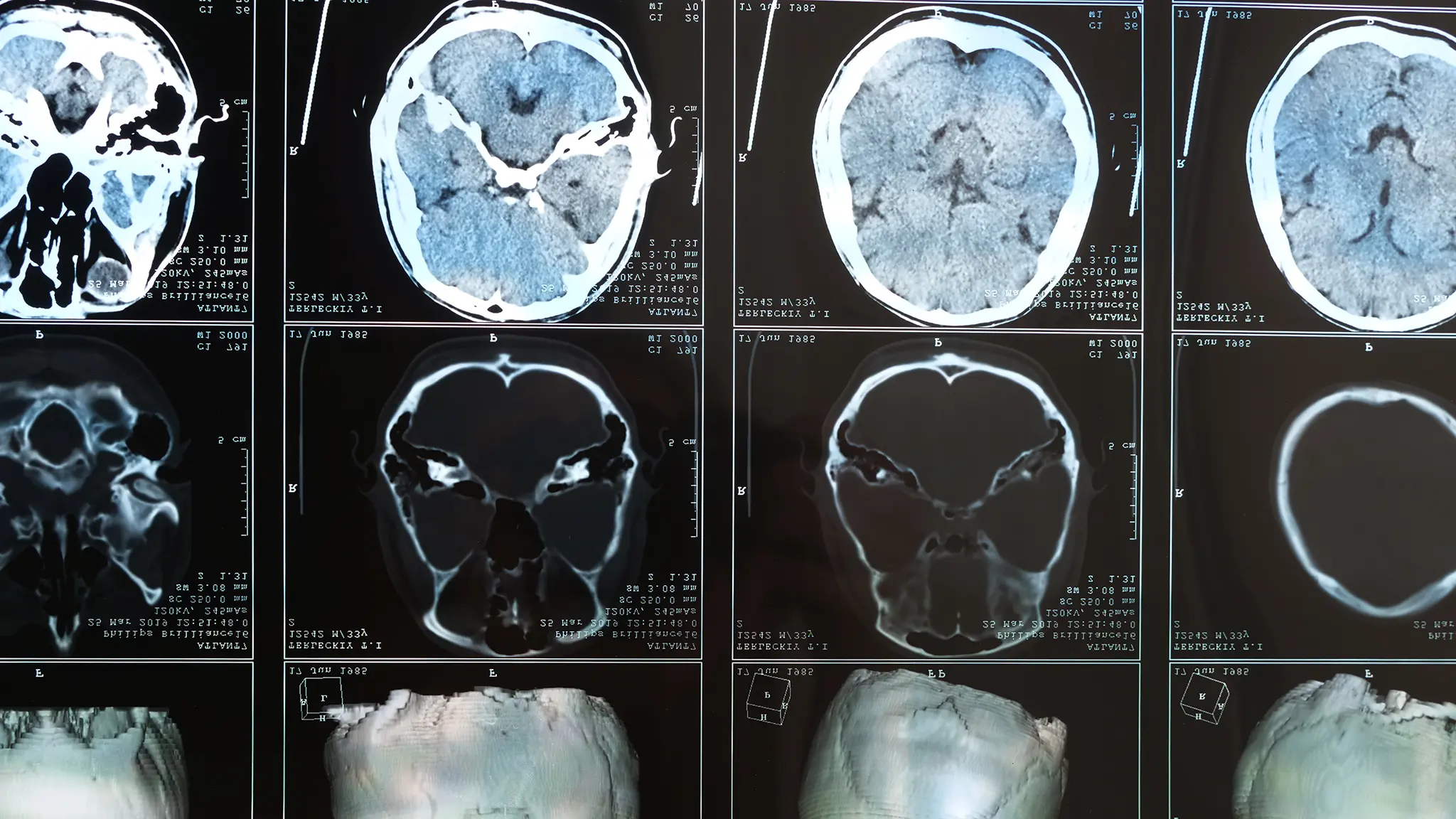 Traumatic Brain Hero